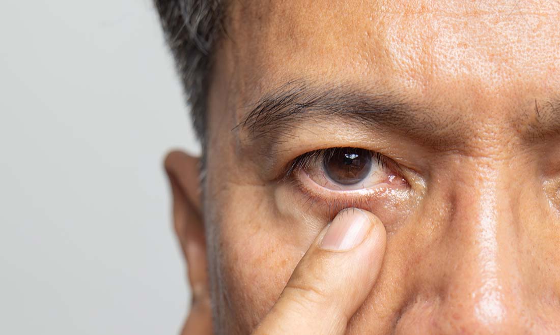 Man pulling his lower eyelid down